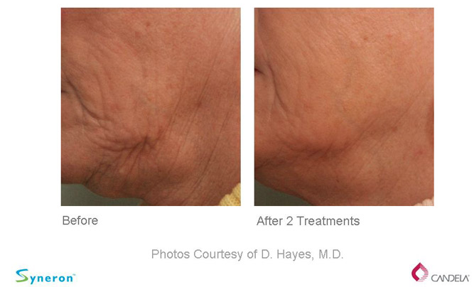Before and After - Sublative Rejuvenation- eMatrix