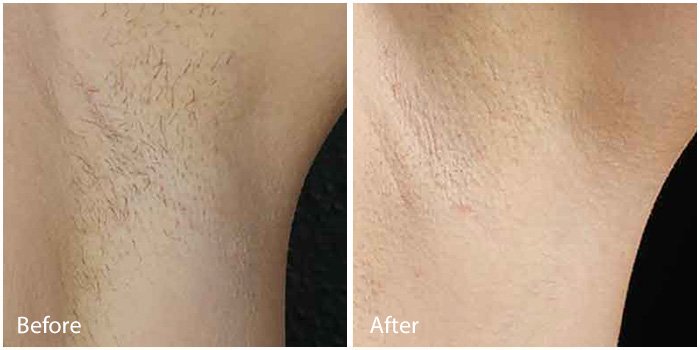 Laser Hair Removal Miami Miami Beach Cost Information